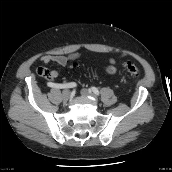 File:Aortic dissection- Stanford A (Radiopaedia 37759-39664 A 143).jpg