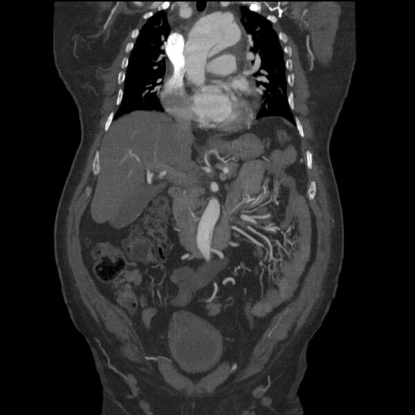 File:Aortic dissection (Radiopaedia 28802-29105 B 12).jpg