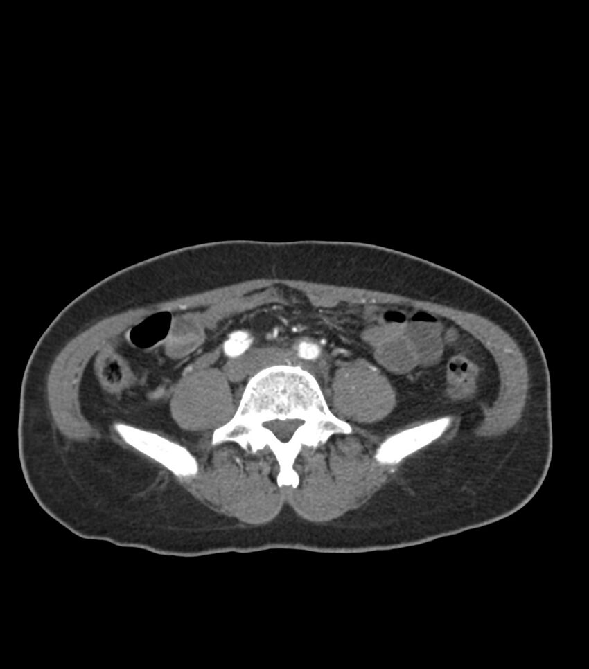Aortic dissection with renal ischemia (Radiopaedia 76573-88338 A 88).jpg