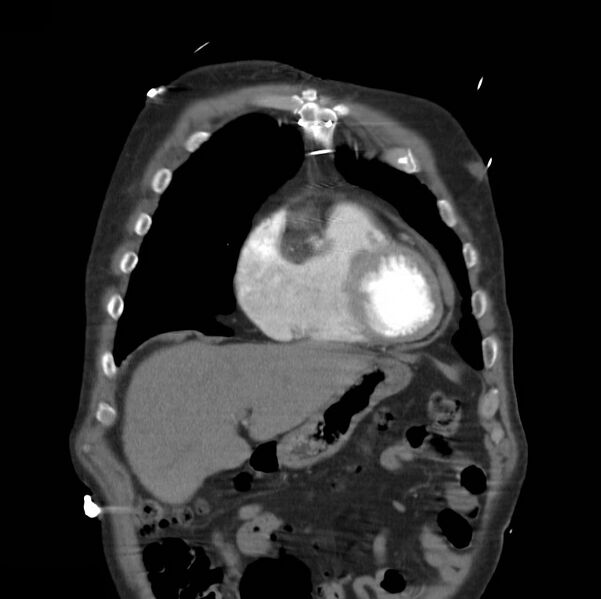 File:Aortic dissection with rupture into pericardium (Radiopaedia 12384-12647 B 7).jpg