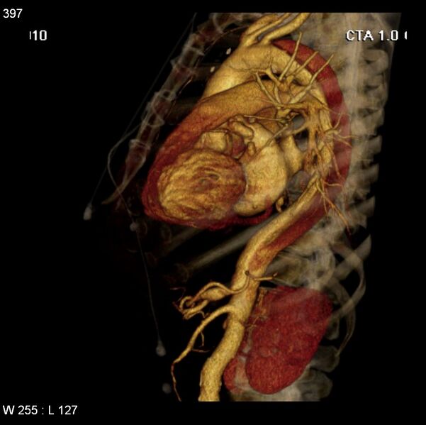 File:Aortic dissection with rupture into pericardium (Radiopaedia 12384-12647 C+ arterial phase 29).jpg