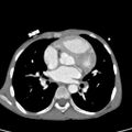 Aortopulmonary window, interrupted aortic arch and large PDA giving the descending aorta (Radiopaedia 35573-37074 B 49).jpg