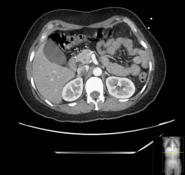 File:Appendicitis (CT angiogram) (Radiopaedia 154713-127660 Axial 139).jpg