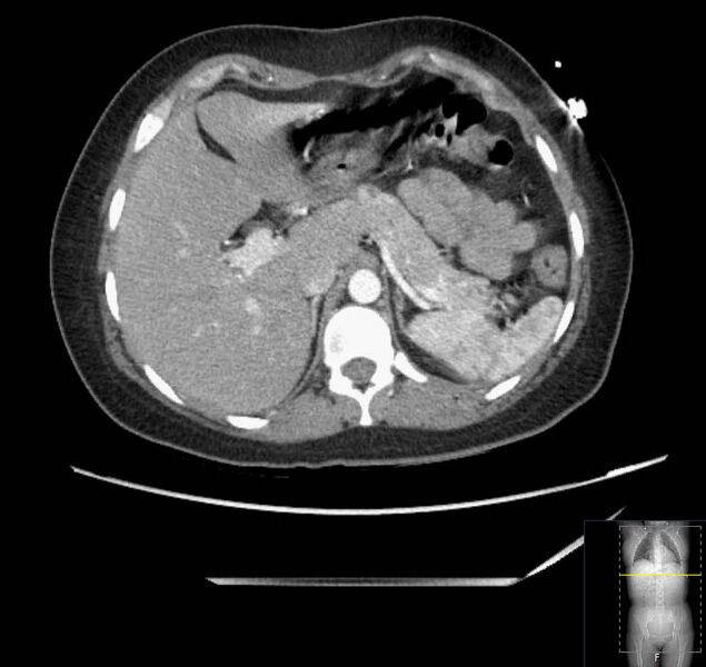File:Appendicitis (CT angiogram) (Radiopaedia 154713-127660 Axial 153).jpg