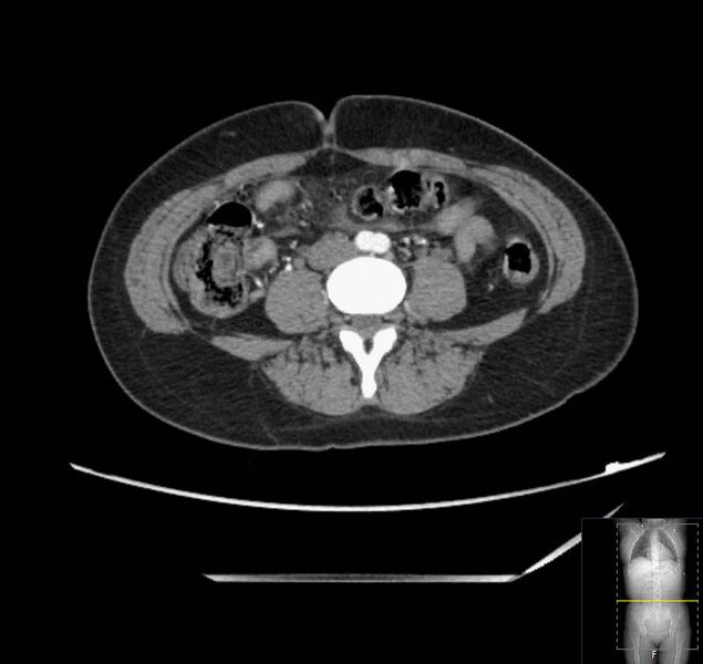 File:Appendicitis (CT angiogram) (Radiopaedia 154713-127660 Axial 51).jpg