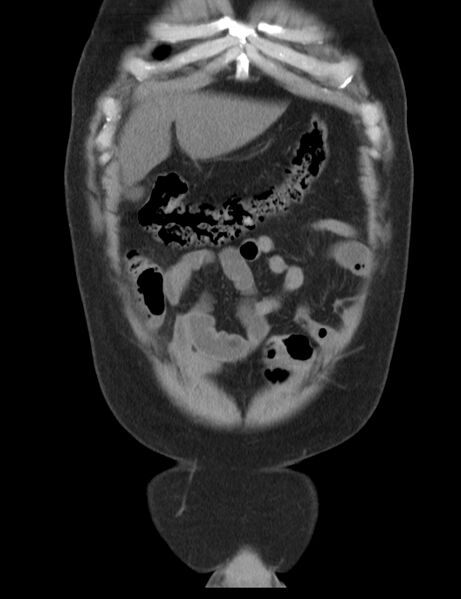 File:Appendicitis and giant appendicolith (Radiopaedia 80251-93588 Coronal non-contrast 7).jpg