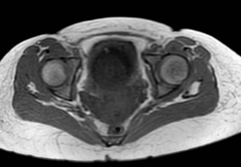File:Appendicitis in gravida (MRI) (Radiopaedia 89433-106395 Axial T1 in-phase 65).jpg