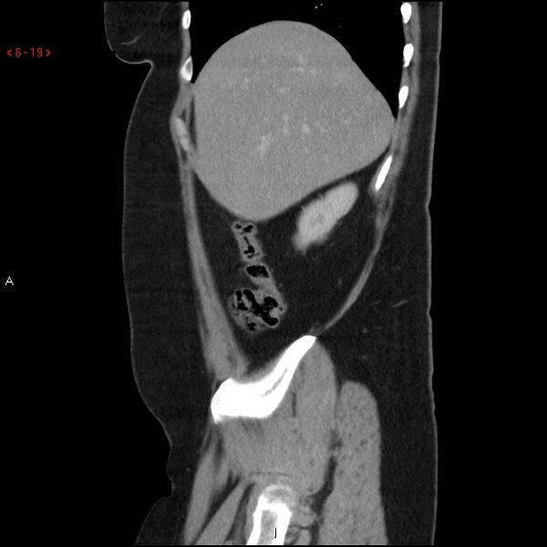 File:Appendicitis with microperforation- promontoric type (Radiopaedia 27268-27442 A 4).jpg