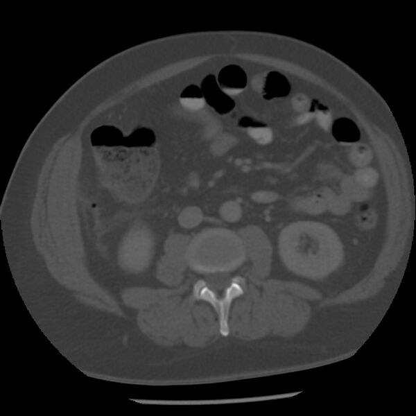 File:Appendicitis with perforation (Radiopaedia 35790-37342 Axial bone window 26).jpg