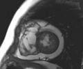 Arrhythmogenic right ventricular cardiomyopathy (Radiopaedia 69431-79307 Short axis cine 69).jpg