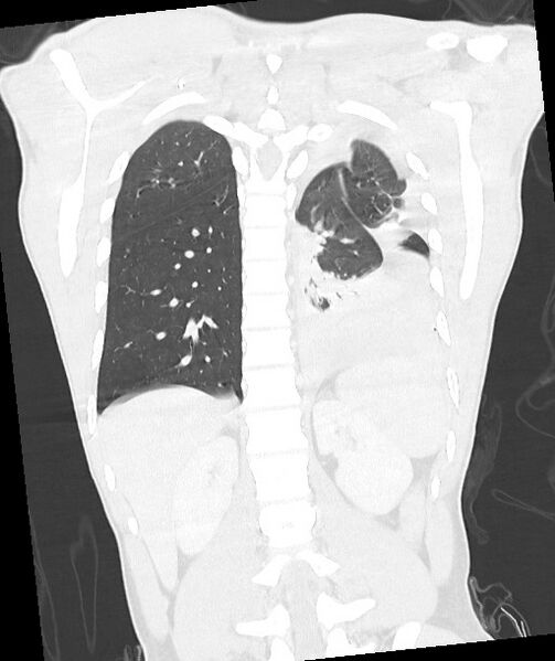 File:Arrow injury to the chest (Radiopaedia 85367-100975 Coronal lung window 97).jpg
