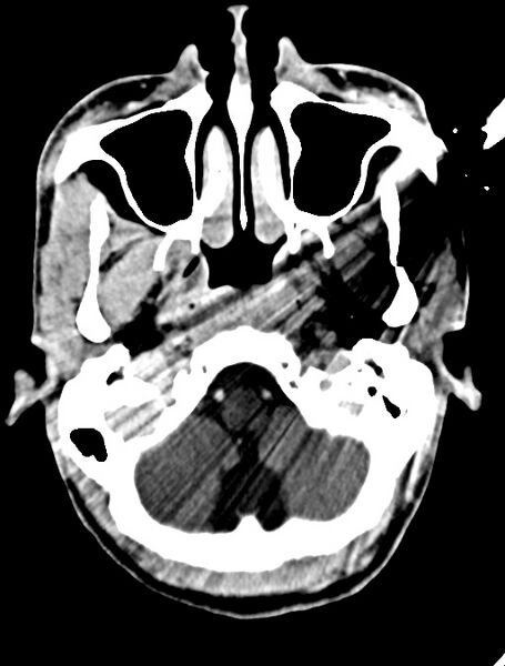 File:Arrow injury to the face (Radiopaedia 73267-84011 Axial C+ delayed 34).jpg
