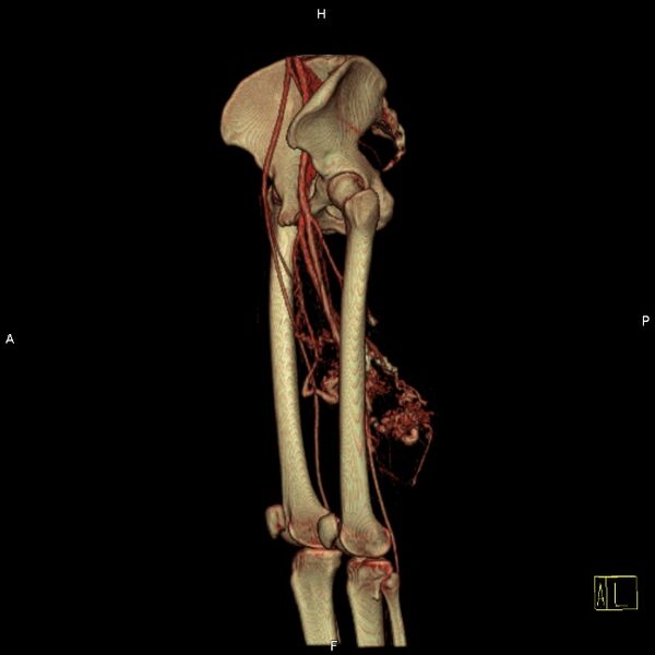 File:Arteriovenous malformation of the thigh (Radiopaedia 14948-14883 C 11).jpg
