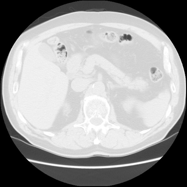 File:Asbestos-related pleural plaques (Radiopaedia 39069-41255 Axial lung window 75).jpg