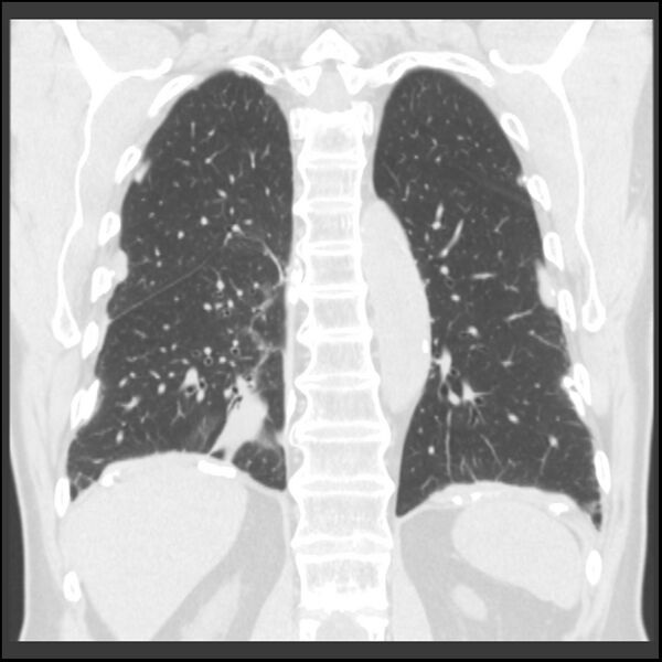 File:Asbestos-related pleural plaques (Radiopaedia 39069-41255 Coronal lung window 25).jpg