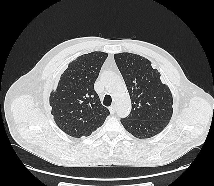 File:Asbestos pleural placques (Radiopaedia 57905-64872 Axial lung window 74).jpg