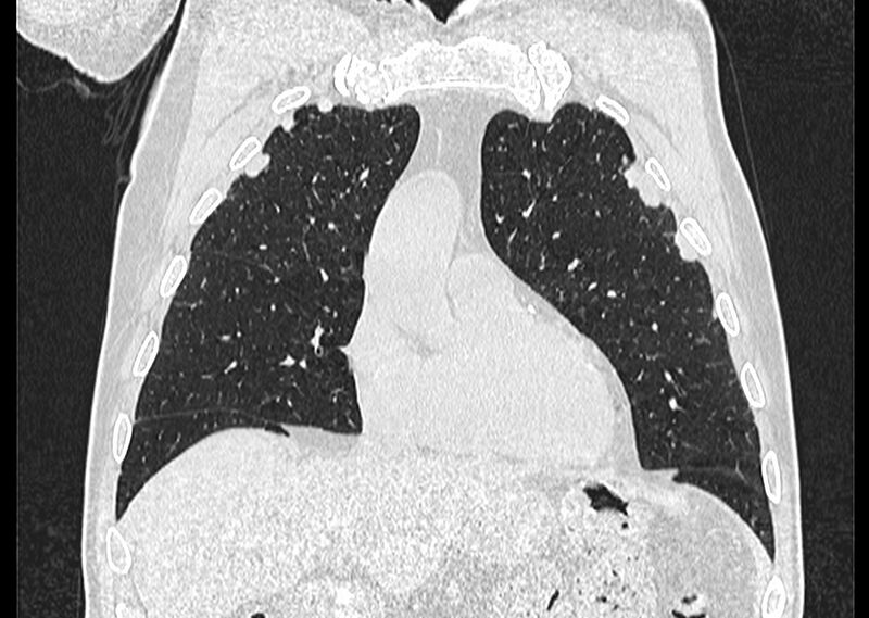 File:Asbestos pleural placques (Radiopaedia 57905-64872 Coronal lung window 80).jpg