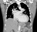 Ascending aortic aneurysm (Radiopaedia 86279-102297 B 35).jpg