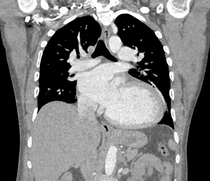 File:Ascending aortic aneurysm (Radiopaedia 86279-102297 B 35).jpg