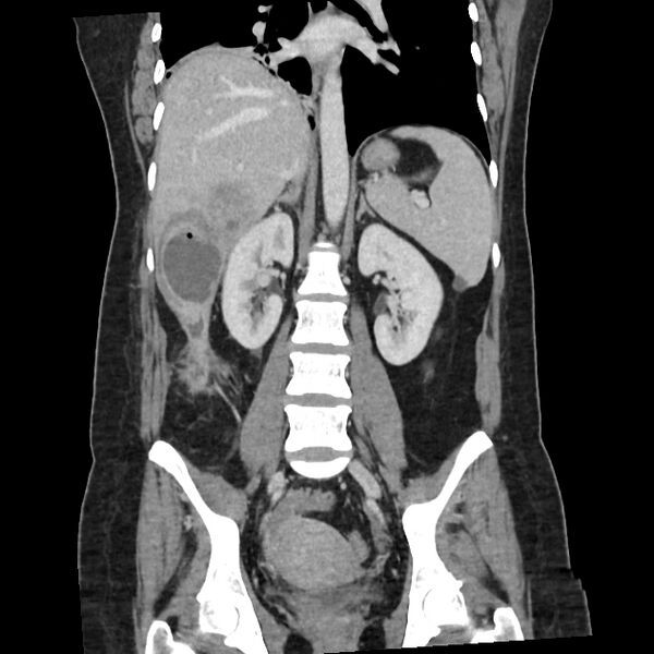File:Ascending retrocecal appendicitis with liver abscesses (Radiopaedia 60066-67615 C 14).jpg