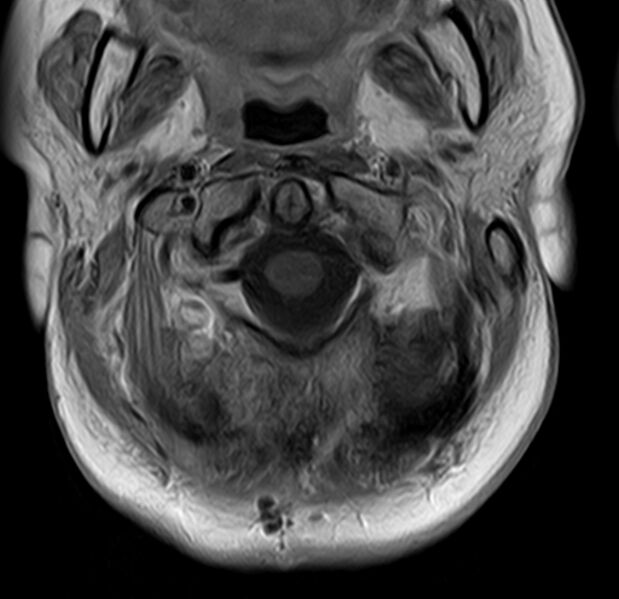 File:Astrocytoma - spinal cord (Radiopaedia 69769-79758 Axial T1 C+ 3).jpg