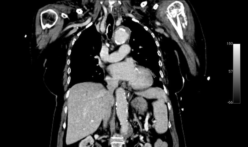 File:Atypical dissection of the thoracic aorta (Radiopaedia 10975-78320 B 17).jpg