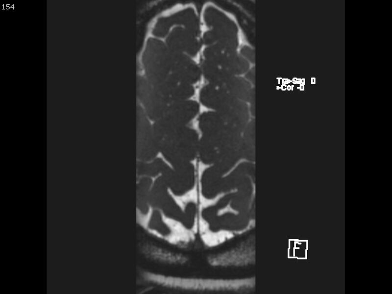 File:Atypical meningioma - intraosseous (Radiopaedia 64915-74572 Axial CISS 154).jpg