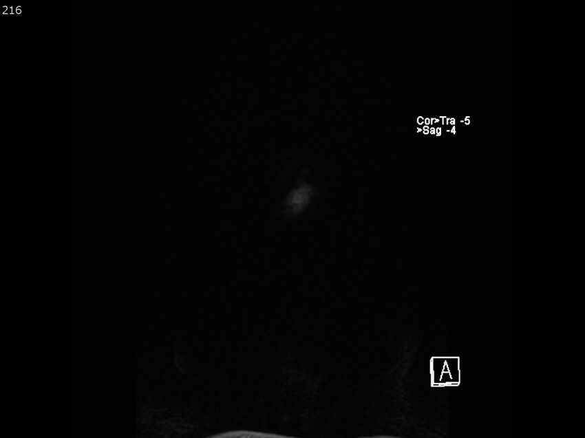 Atypical meningioma - intraosseous (Radiopaedia 64915-74572 Coronal T1 216).jpg