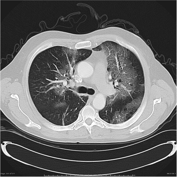 File:Atypical pneumonia - Q fever (Radiopaedia 21993-21989 lung window 16).jpg