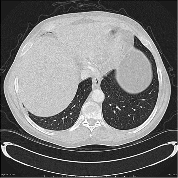File:Atypical pneumonia - Q fever (Radiopaedia 21993-21989 lung window 40).jpg