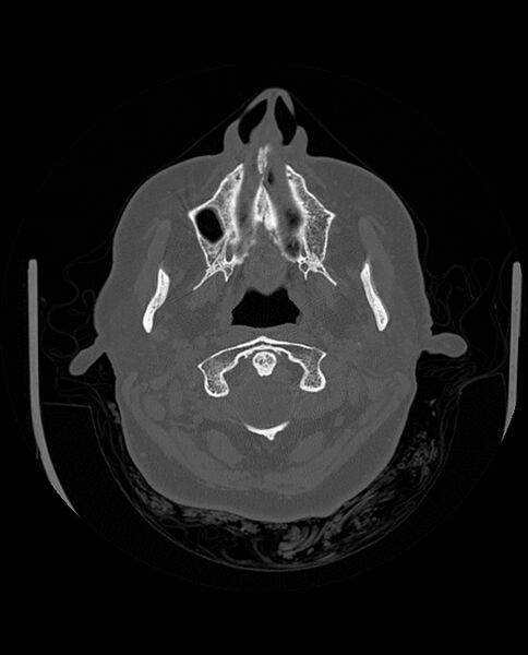 File:Automastoidectomy with labyrinthine fistula (Radiopaedia 84143-99411 Axial non-contrast 42).jpg