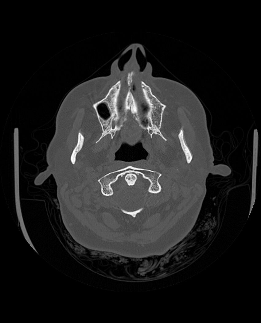 Automastoidectomy with labyrinthine fistula (Radiopaedia 84143-99411 Axial non-contrast 42).jpg