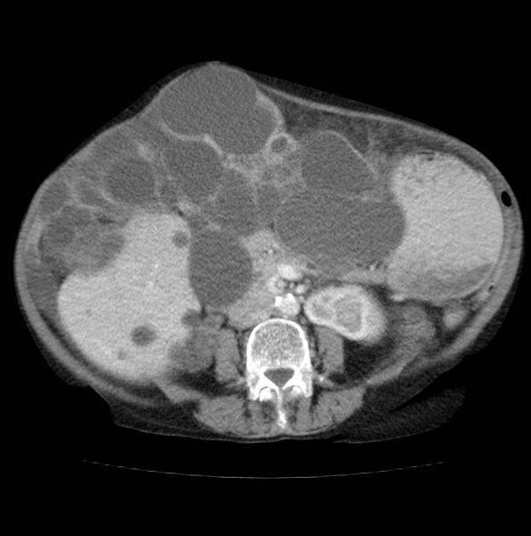 File:Autosomal dominant polycystic kidney disease (Radiopaedia 16777-16490 A 33).jpg