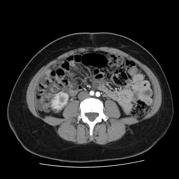 File:Autosomal dominant polycystic kidney disease (Radiopaedia 23061-23093 B 41).jpg