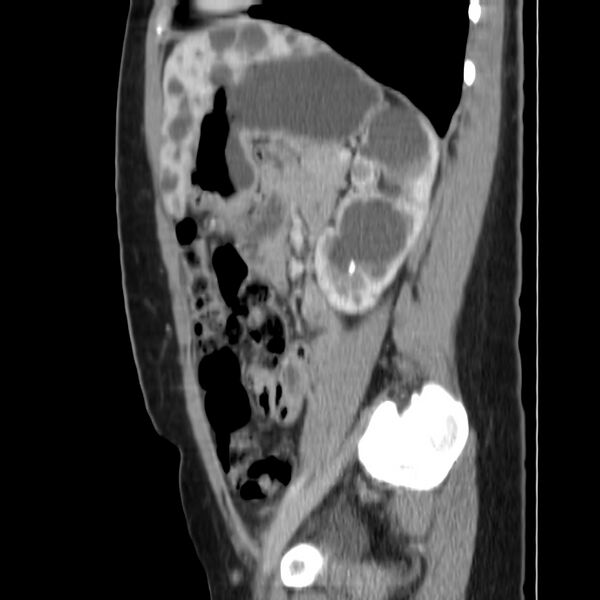 File:Autosomal dominant polycystic kidney disease (Radiopaedia 23061-23093 F 38).jpg