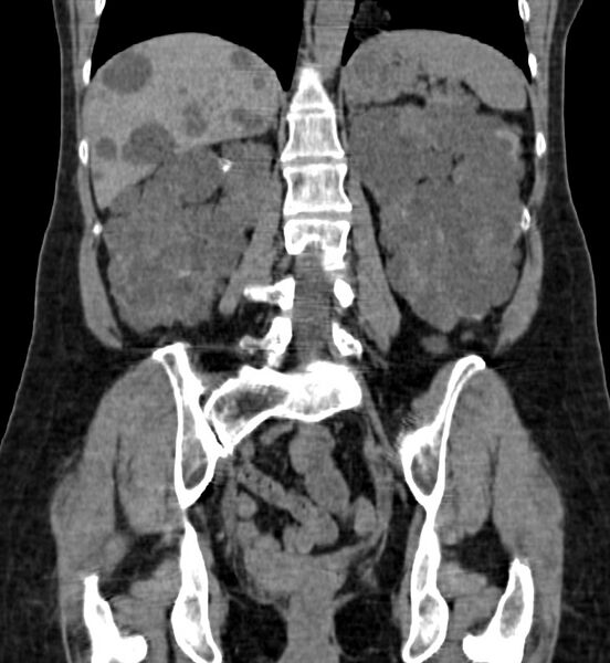 File:Autosomal dominant polycystic kidney disease (Radiopaedia 41918-44922 Coronal non-contrast 32).jpg
