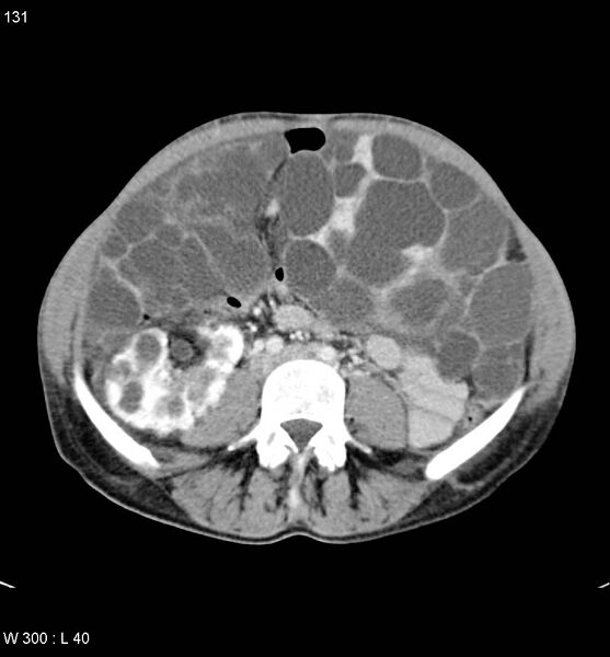 File:Autosomal dominant polycystic kidney disease with extensive hepatic involvement (Radiopaedia 5204-6971 B 18).jpg