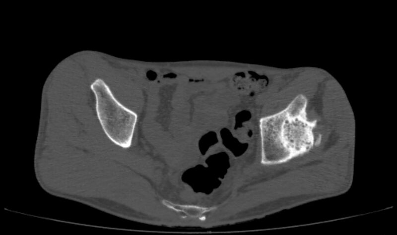 File:Avascular necrosis of the left hip (Radiopaedia 75068-86125 Axial bone window 16).jpg