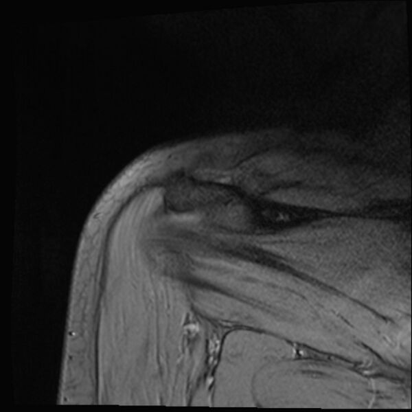 File:Avulsion fracture - greater tuberosity of humerus (Radiopaedia 71216-81515 Coronal T2 5).jpg