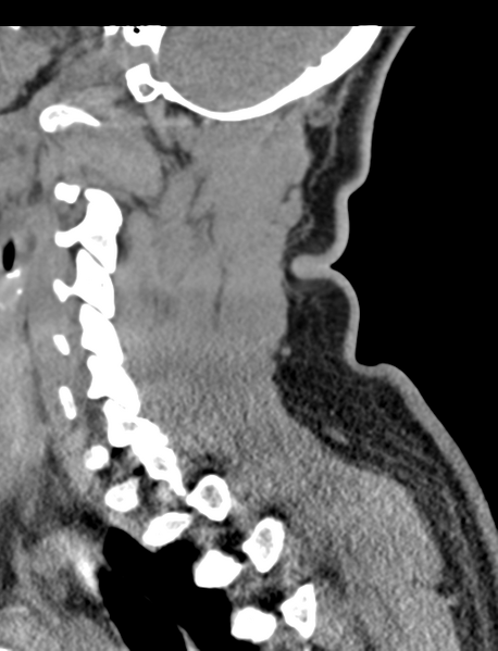File:Axis peg fracture (type 3) and atlas lateral mass (type 4) fracture (Radiopaedia 37474-39324 D 53).png