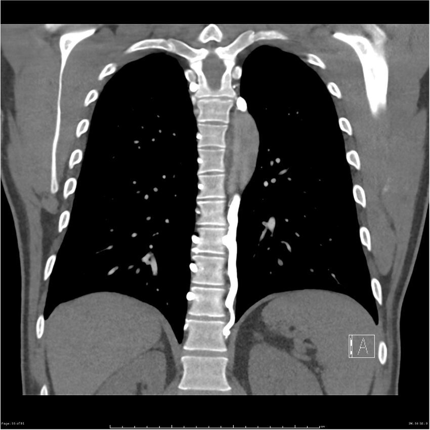 Azygos venous system anatomy (CT pulmonary angiography) (Radiopaedia 25928-26077 Coronal C+ CTPA 55).jpg