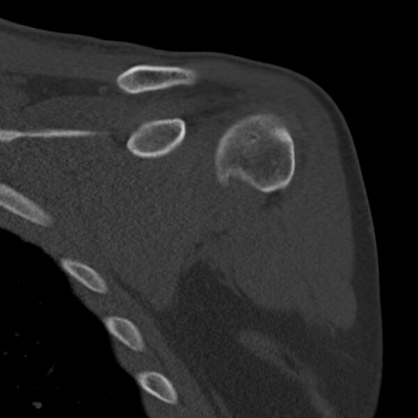 File:Bankart lesion (Radiopaedia 22771-22798 Coronal bone window 10).jpg