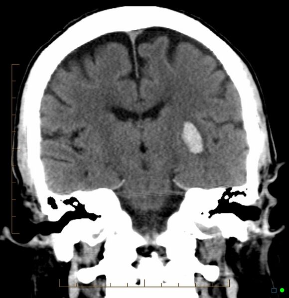 File:Basal ganglia hemorrhage (CT) (Radiopaedia 2672-6384 Coronal non-contrast 1).jpg