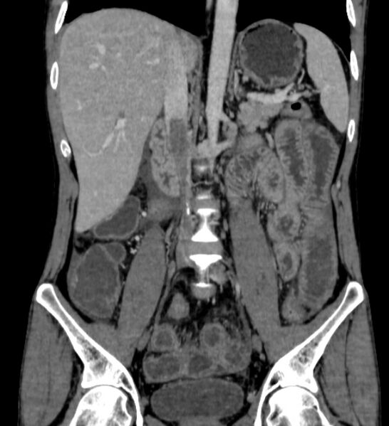 File:Behçet's disease- abdominal vasculitis (Radiopaedia 55955-62570 B 31).jpg