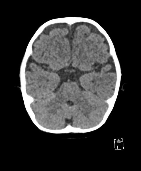 File:Benign enlargement of subarachnoid spaces in infancy (BESS) (Radiopaedia 87459-103795 Axial non-contrast 63).jpg