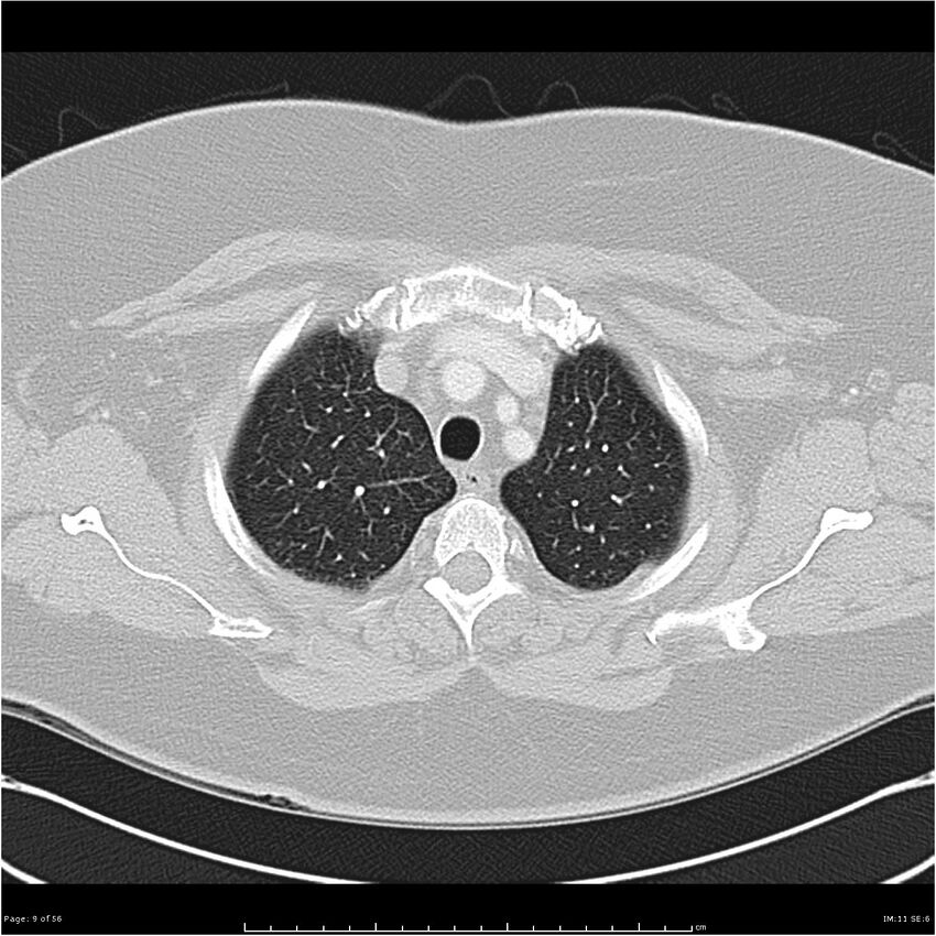 Benign metastasizing leiomyoma (Radiopaedia 26803-26962 Axial lung window 9).jpg
