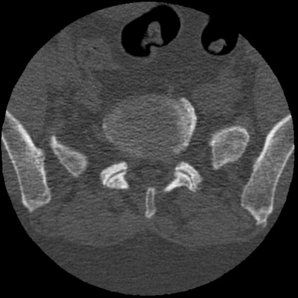 File:Bertolotti syndrome (Radiopaedia 24864-25128 Axial bone window 28).jpg