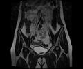 Bicornuate bicollis uterus (Radiopaedia 61626-69616 Coronal T2 11).jpg