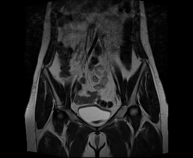 File:Bicornuate bicollis uterus (Radiopaedia 61626-69616 Coronal T2 11).jpg