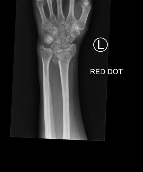 File:Bilateral Colles fractures (Radiopaedia 86290-102312 Frontal 1).jpg
